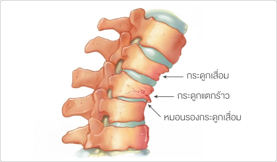 ภาวะหมอนรองและกระดูกเสื่อม